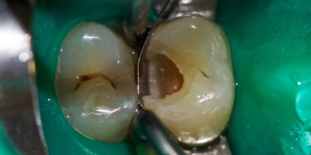 Лечение зуба под анастезией с применением коффердама фото до лечения
