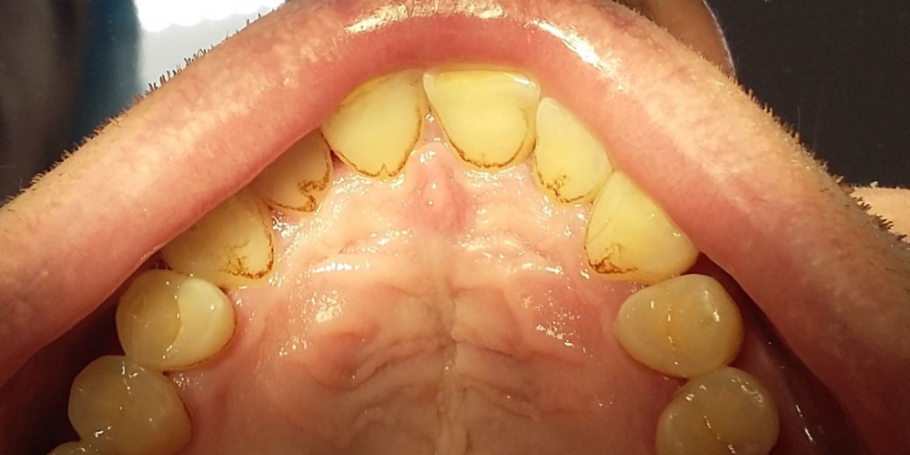 Верхняя челюсть фото до профессиональной чистки зубов. Результат профессиональной гигиены полости рта