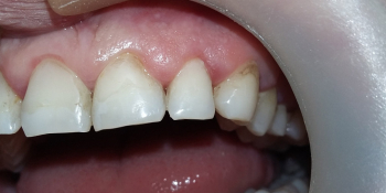 Реставрация клиновидного дефекта зубов фото после лечения
