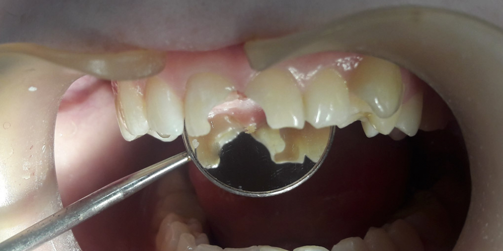  Художественная реставрация передних зубов композитным материалом