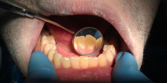 Профессиональная чистка зубов (дентикюр) с применением процедуры Air-Flow фото после лечения