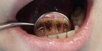 Чистка зубного налета и снятие зубного камня фото до лечения