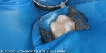  Лечение кариеса жевательного зуба