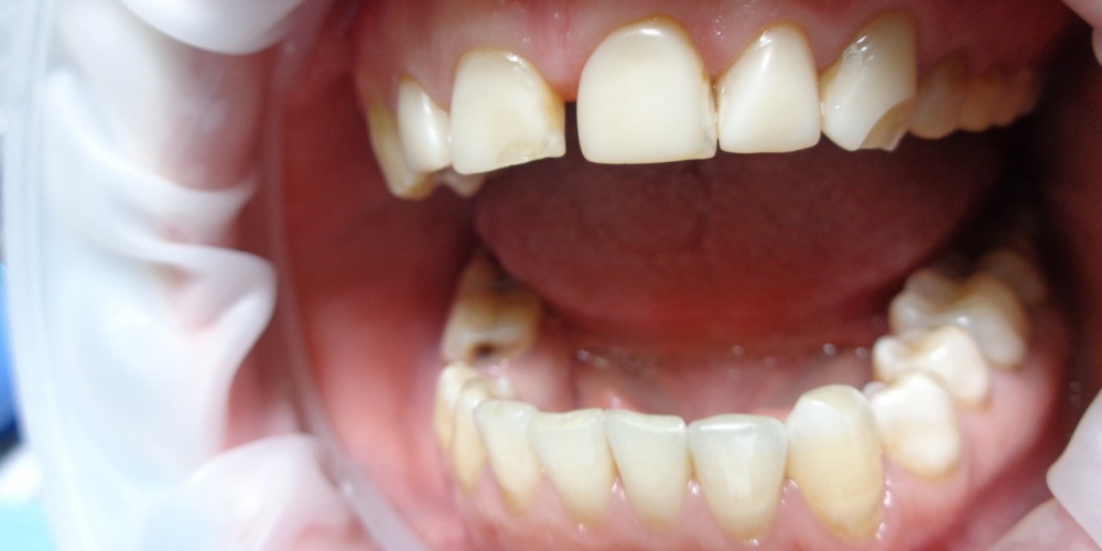  Реставрация зубов композитными винирами