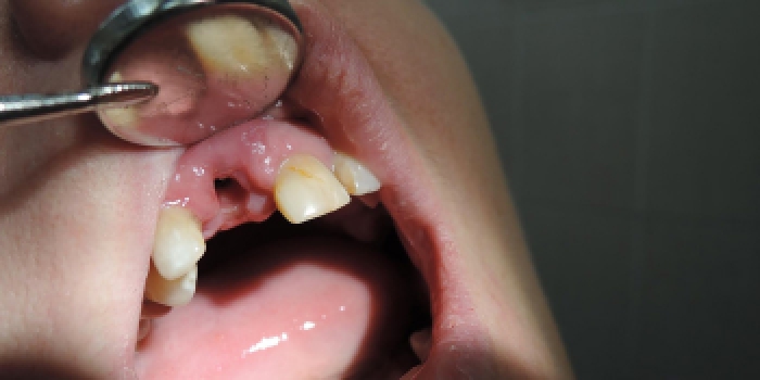 Одномоментная имплантация зубов с последующим протезированием, импланты MIS фото до лечения