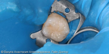 Лечение кариеса зуба 36, восстановление анатомической формы фото после лечения