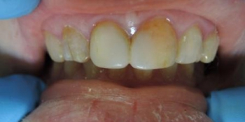 Эстетическая реставрация зубов, поврежденных флюорозом фото до лечения