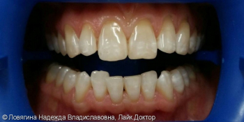 Отбеливание зубов Philips ZOOM 4 White Speed фото до лечения