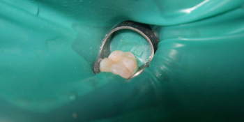 Лечение глубокого кариеса жевательного зуба фото после лечения