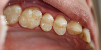 Результат лечения кариеса четырех зубов за один прием фото после лечения
