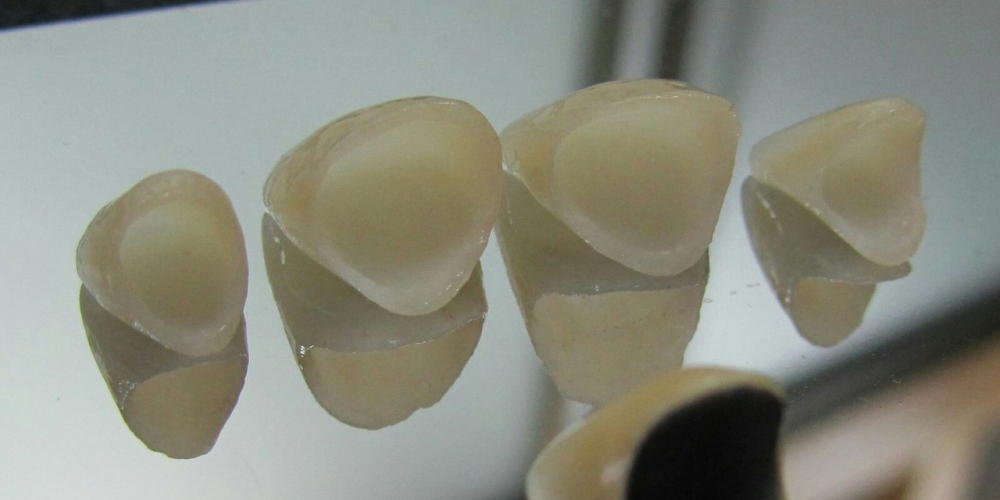  Цельнокерамические коронки e-max на передние зубы