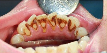 Профессиональная чистка зубов ультразвуком с Air-Flow фото до лечения