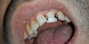 Результат восстановления передних зубов фото до лечения