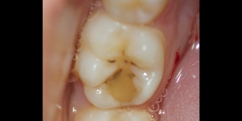 Лечение среднего кариеса на жевательном зубе + реставрация фото до лечения