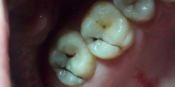 Лечение кариеса, реставрация жевательных зубов, жалоба на боль в зубах фото до лечения