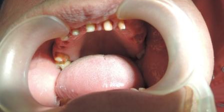 Зубы пациента подготовлены к протезированию Сложный случай с имплантацией и протезированием