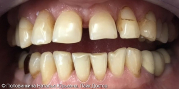 Эстетическая реставрация зубов фото до лечения