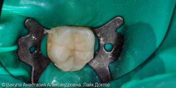 Лечение пульпита, зуб 46, восстановление анатомической формы фото после лечения