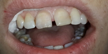 Внутриканальное отбеливание и реставрация передних зубов фото до лечения