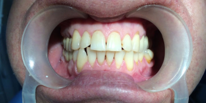 Профессиональная чистки зубов Air-flow с сильным налетом от чая и сигарет фото после лечения