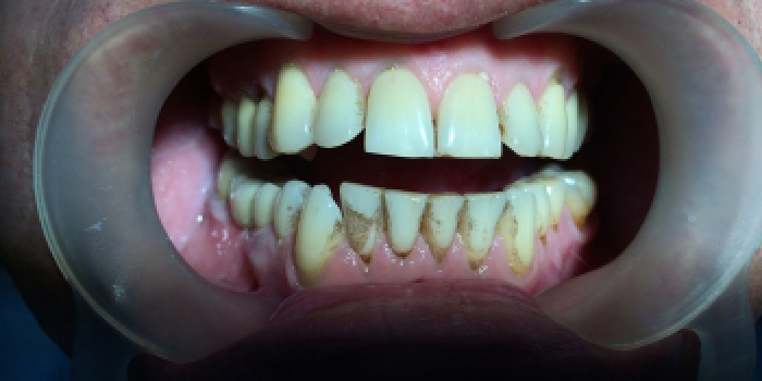 Профессиональная чистки зубов Air-flow с сильным налетом от чая и сигарет фото до лечения